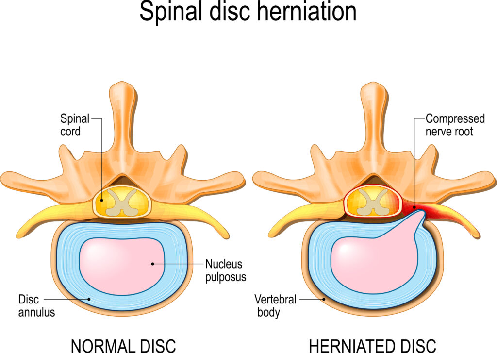 Spinal Disc Herniation